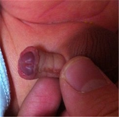 小孩尿道下裂症狀