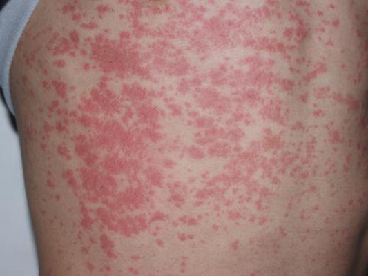 艾滋病紅疹症狀