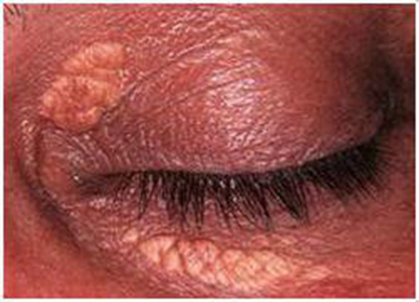 眼部皮膚黃色瘤病