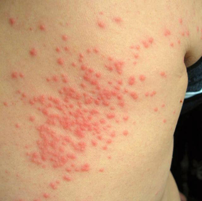 小兒猩紅熱症狀