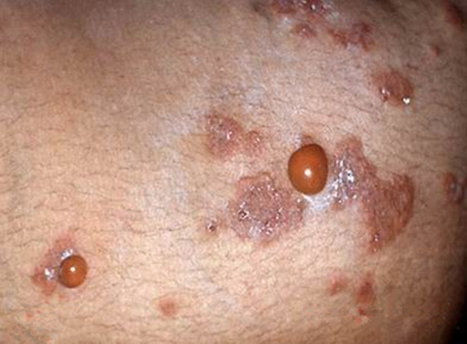 皰疹樣大皰性皮膚病嚴重