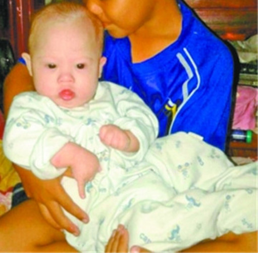 小兒唐氏綜合症孩子