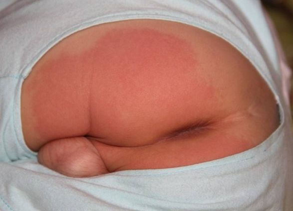 寶寶紅屁屁照片 (51) 