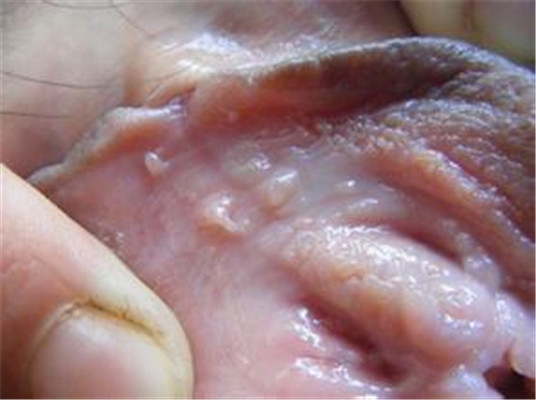 性病性淋巴肉芽腫套圖 (56) 