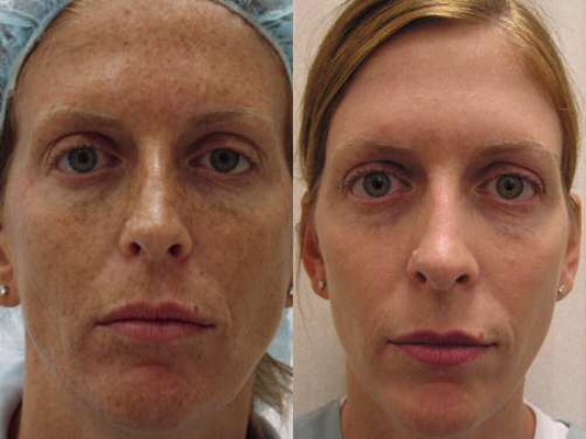 激素臉排毒症狀 (40) 