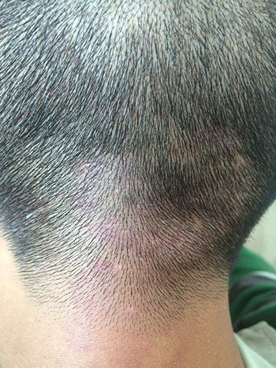 頭皮脂溢性皮炎 (9) 