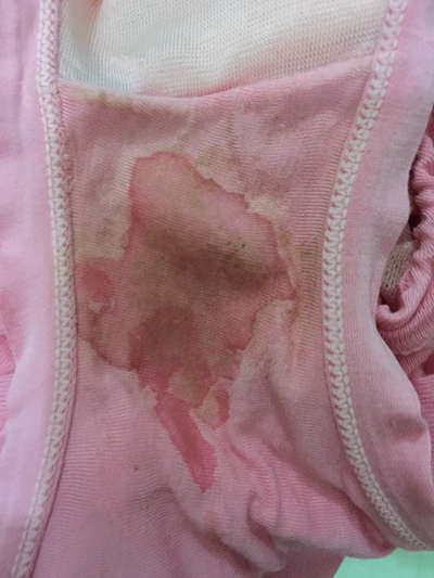 先兆流產分泌物