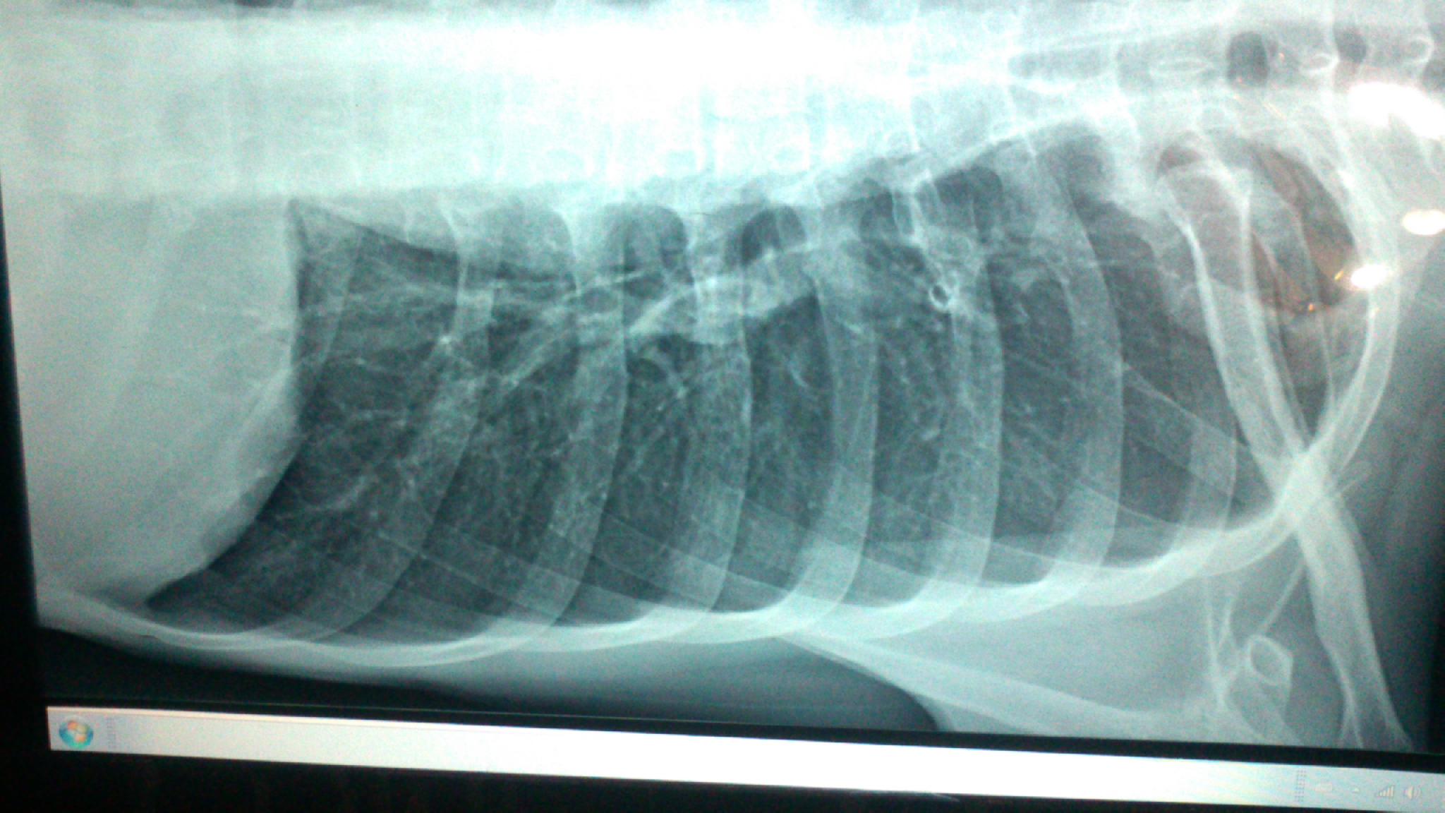 ＿雙肺肺纖維化的