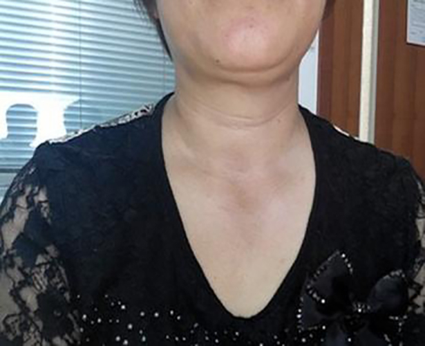 亞急性甲狀腺炎