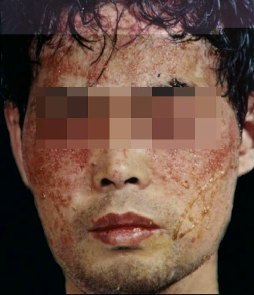 明星臉上患異位性皮炎