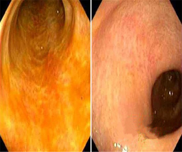 輕微潰瘍性結腸炎前後對比