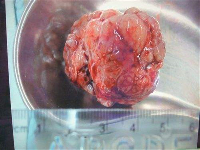 切除的卵巢癌