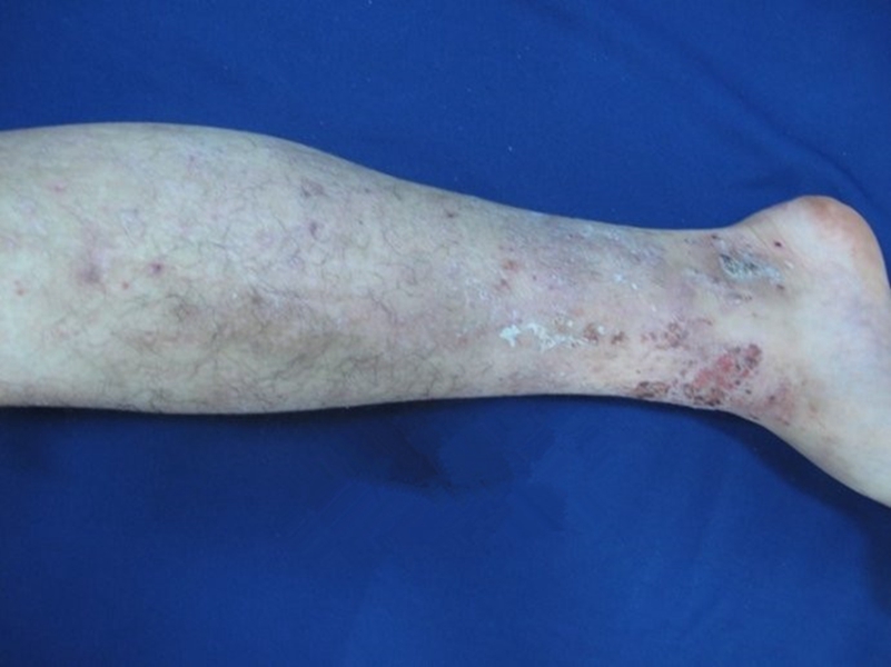 腿部異位性皮炎