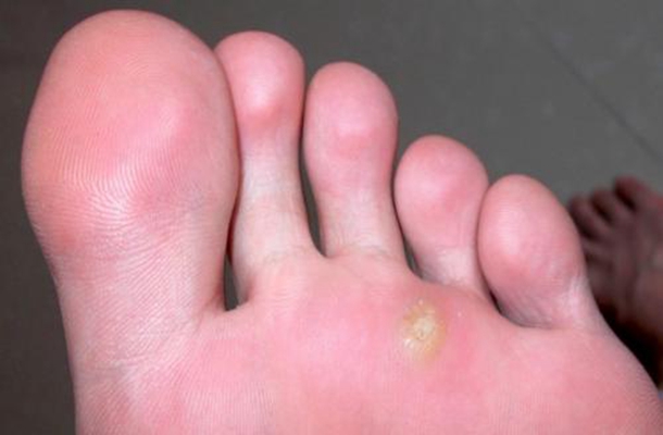腳底蹠疣早期