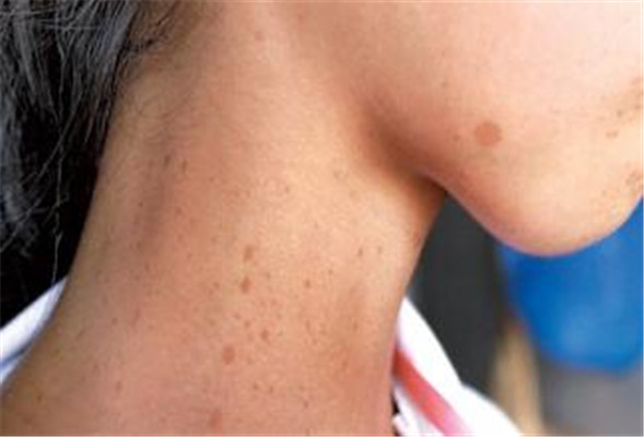 牛奶咖啡斑 (49) 