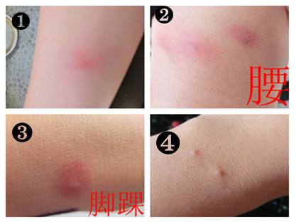 被跳蚤咬的症狀