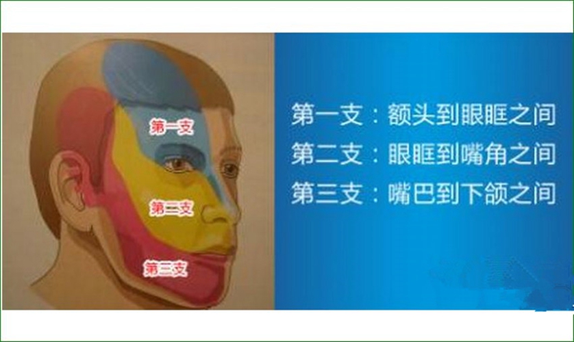 什麼是三叉神經痛的扳機點