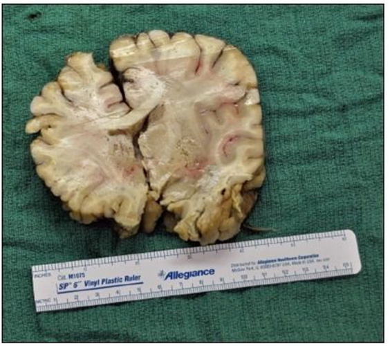 隱球菌性腦膜腦炎