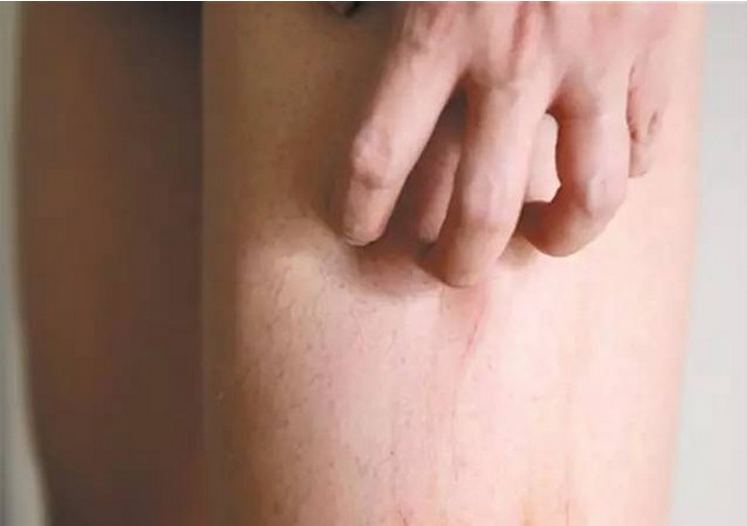 腿部夏季皮炎症狀