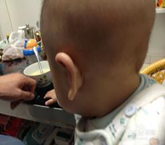 幼兒甲狀腺腫大表現