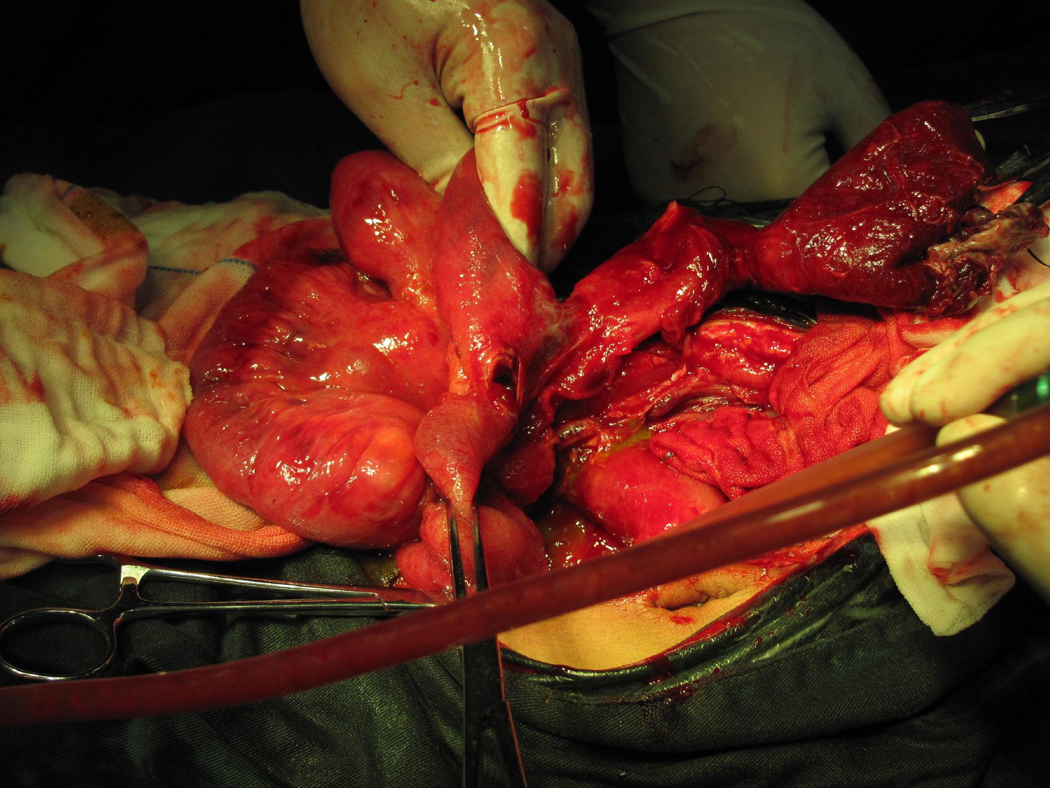 高清腸粘連手術