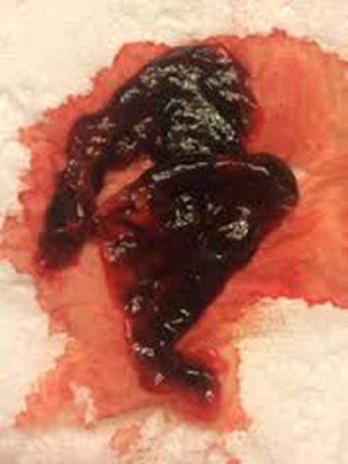 早孕藥流排出孕囊的實體