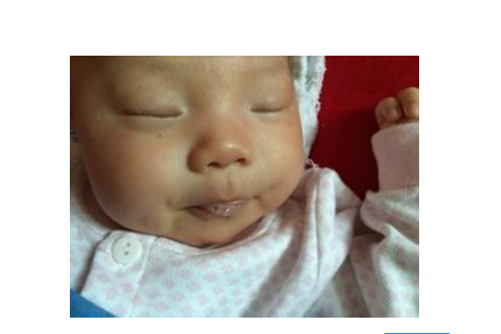 新生兒肺炎吐泡泡 (46) 