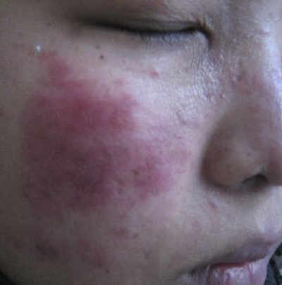 系統性紅斑狼瘡診斷標準 (44) 