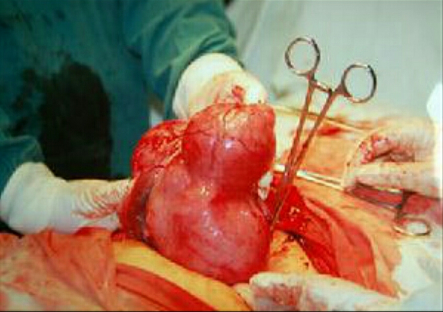 孕婦巨大卵巢囊腫