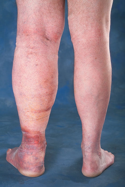 肢端肥大症  (50) 