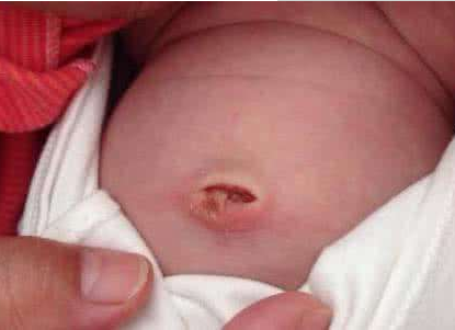 寶寶臍帶脫落後