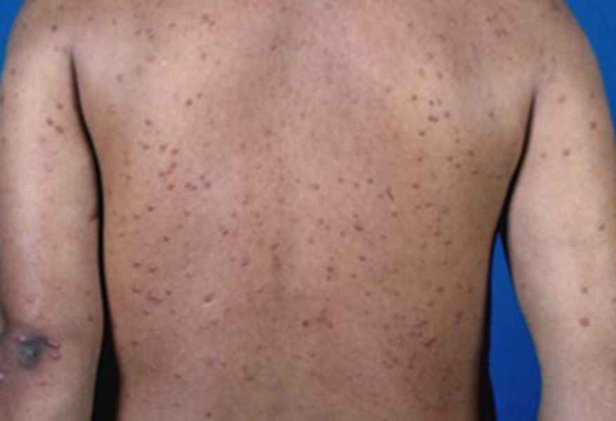 輕微皮膚黃色瘤病