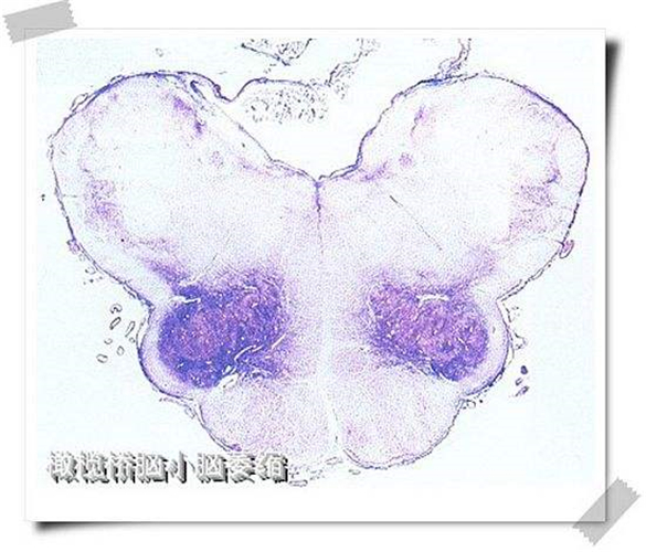 橄欖橋腦腦萎縮