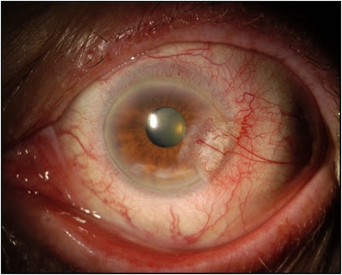 白內障的早期症狀