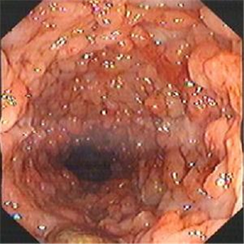 嚴重潰瘍性結腸炎四周