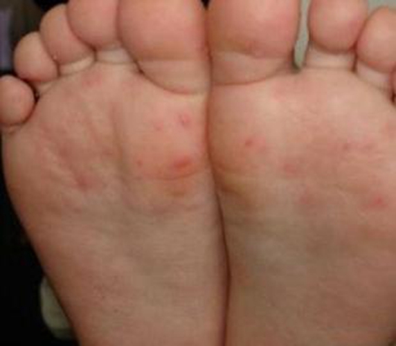 春季小兒急疹多發 