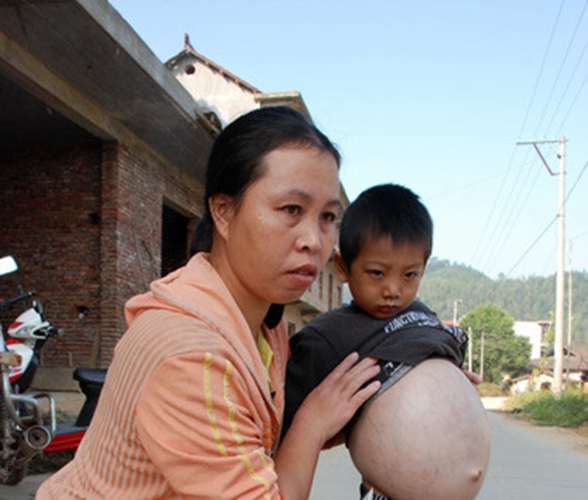 小孩會肝腹水症狀