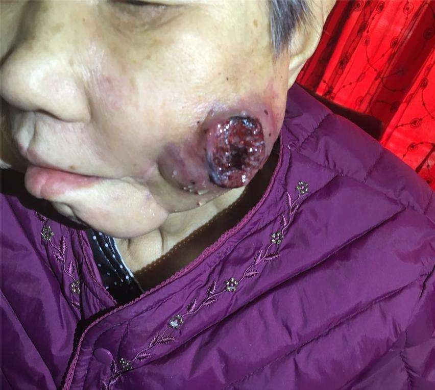 老年女性頰癌症狀