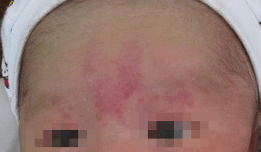 嬰兒額頭放射性皮炎