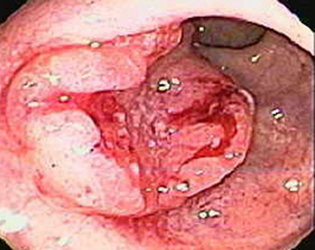 右半結腸癌浸潤型常見臨床 特點 