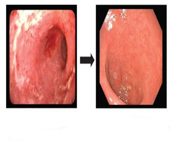 潰瘍性結腸炎治療前後對比