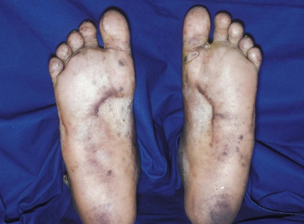 脈管炎早期症狀