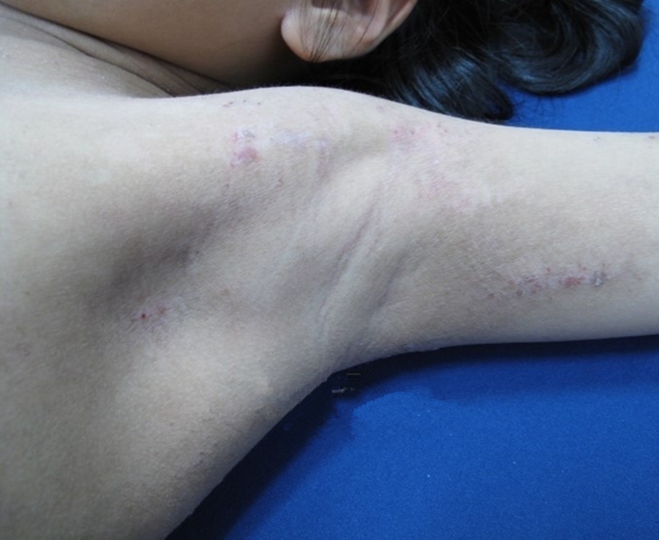 腋窩異位性皮炎