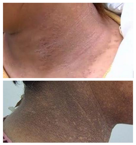 頸部皮膚黑變病對比的