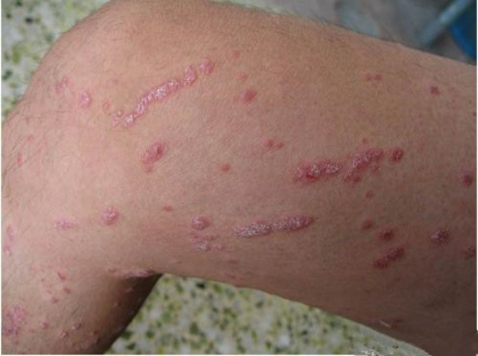 艾滋病紅疹症狀