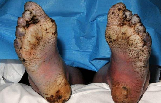 脈管炎早期症狀