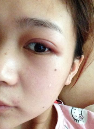 眼睛麥粒腫初期