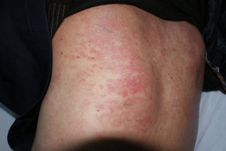 藥疹與皮膚腫瘤