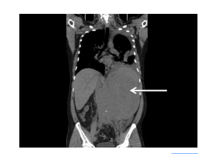 精索曲張睪丸下墜時