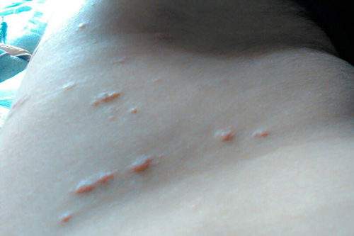 被跳蚤咬的症狀